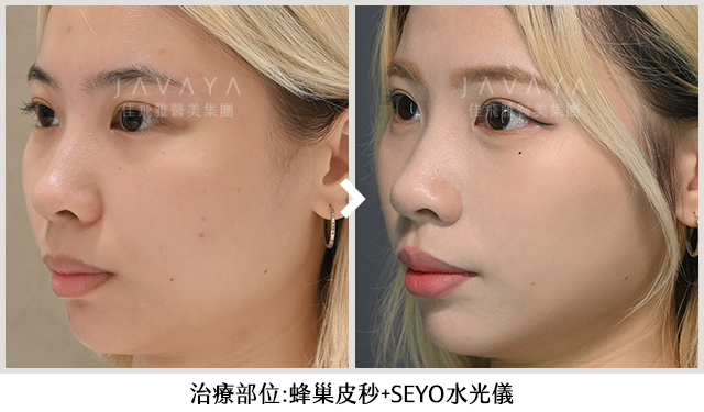 SEYO水光儀+蜂巢皮秒 Before/After